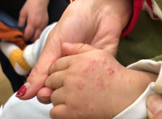 孩子有湿疹护理方面怎么科学护理「孩子湿疹护理要注意什么」