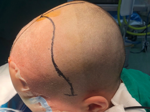 婴儿颅型检测(婴儿头颅检查)